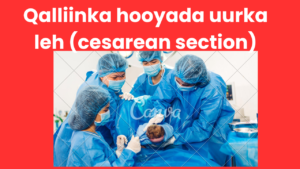 Qalliinka hooyada uurka leh (cesarean section)